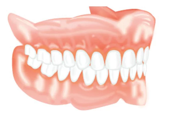 Denture Stabilization with our Dentist In Redmond