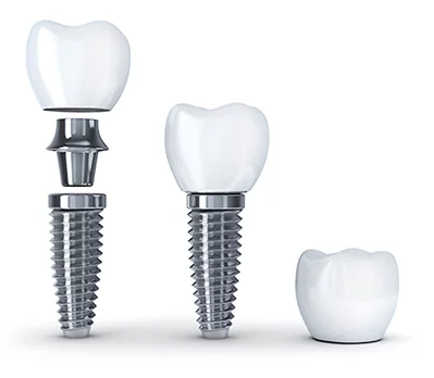 dental implants by Redmond OR Dentist